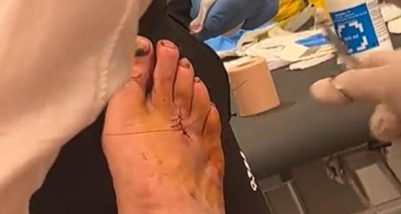  - La blessure sanglante de Benzema, recousu après son match !