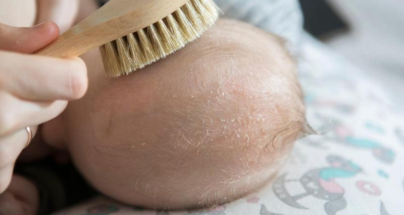  - Les croûtes de lait retarderaient la pousse des cheveux chez les bébés : nos conseils pour en venir à bout rapidement