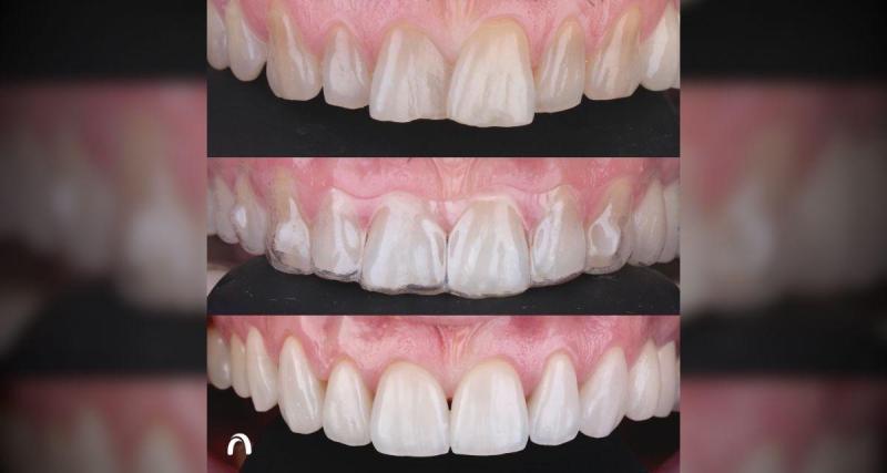  - Comment les gouttières invisibles transforment votre alignement dentaire ?