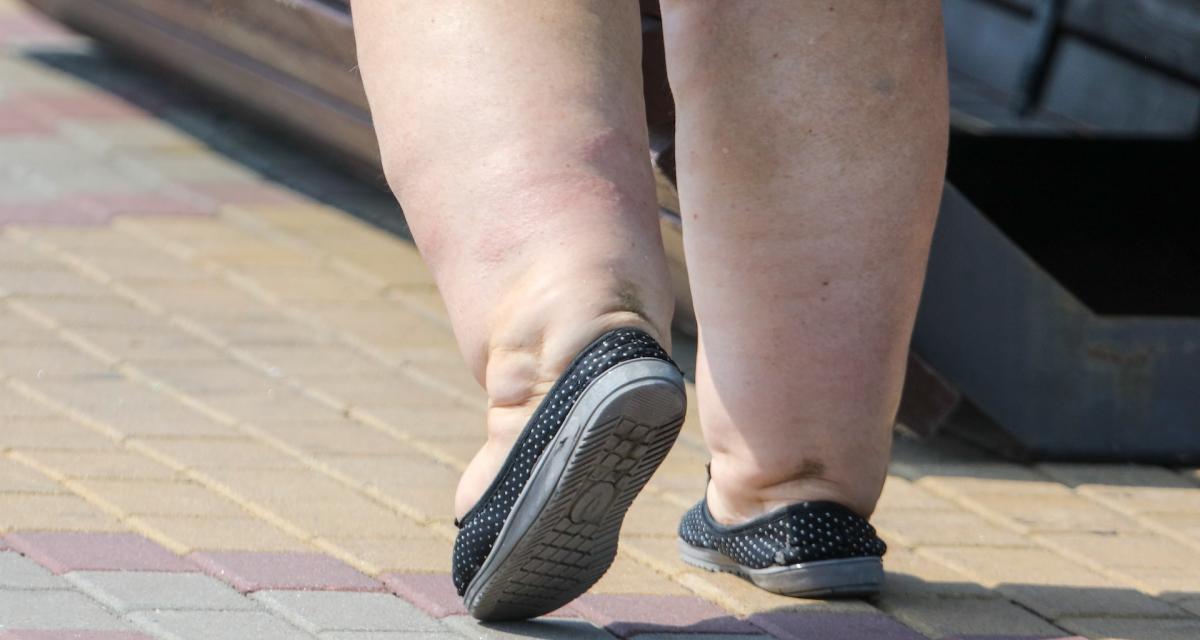 Une dame atteinte du syndrome des jambes poteaux marche dans la rue.